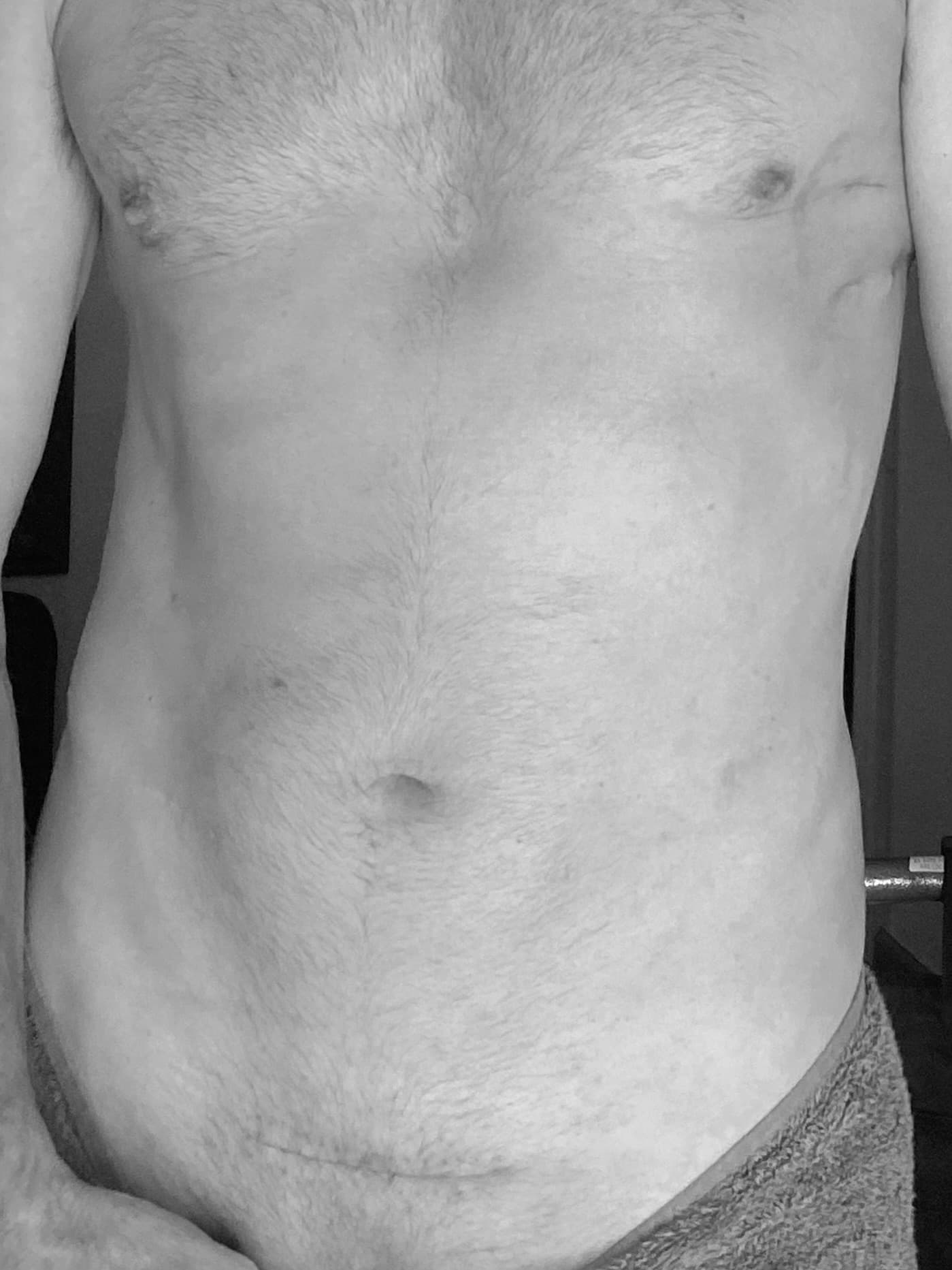 Surgical scar on Michael Cavett's pelvis