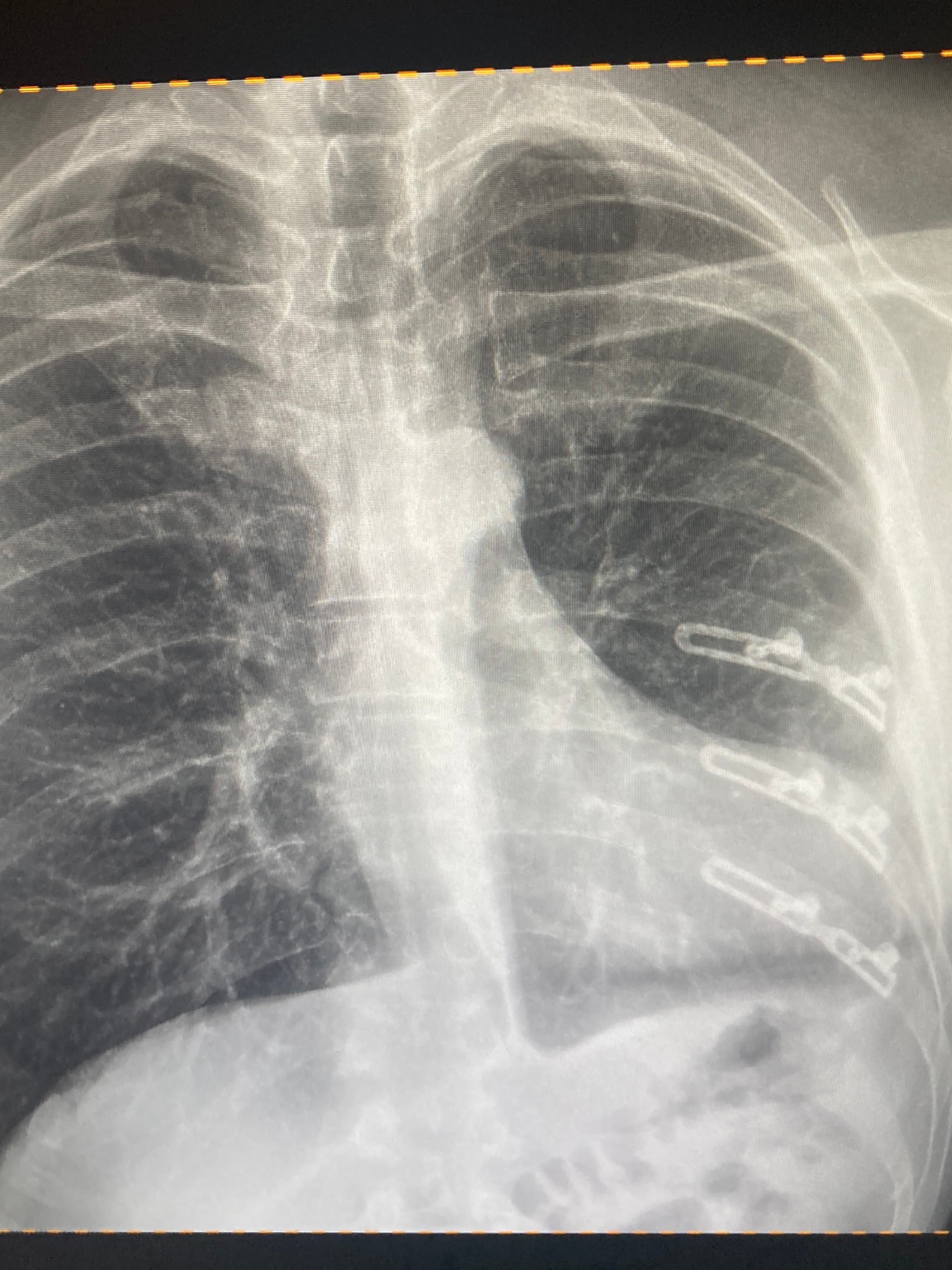 X-ray of surgical staples along Michael Cavett's ribs